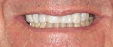 FMR Smile try in