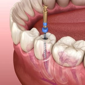 how the pulp of a tooth can be removed through root canal treatment