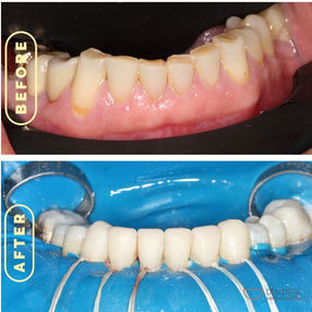 lower teeth before and after.jpg