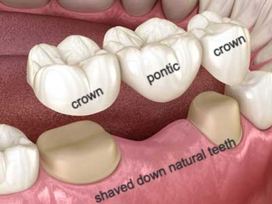 Dental Bridge
