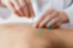 Traditional Chinese Acupuncture