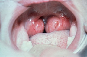 Is it safe to remove adenoids and tonsils for my child?