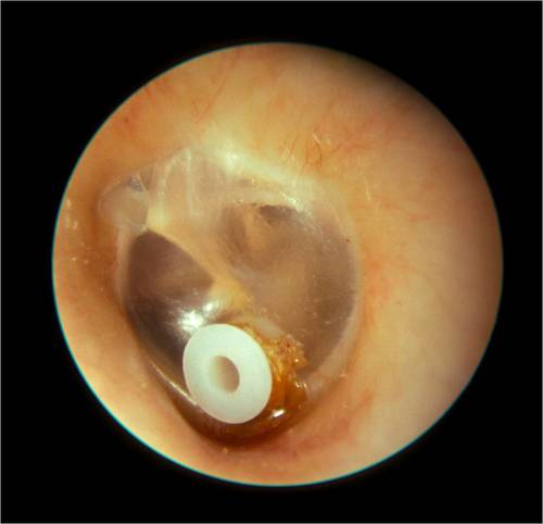 GLUE EAR