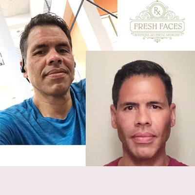Cosmetic Injectables