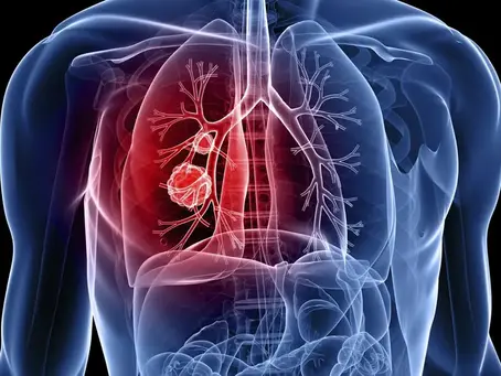 Óbitos causados por embolia pulmonar continuam elevados, apesar dos avanços no tratamento.
