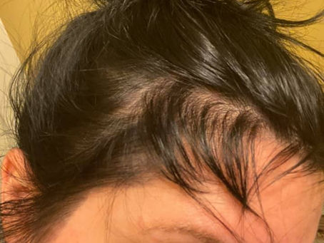 Postpartum Hair Loss - Nurturing your Tresses Naturally