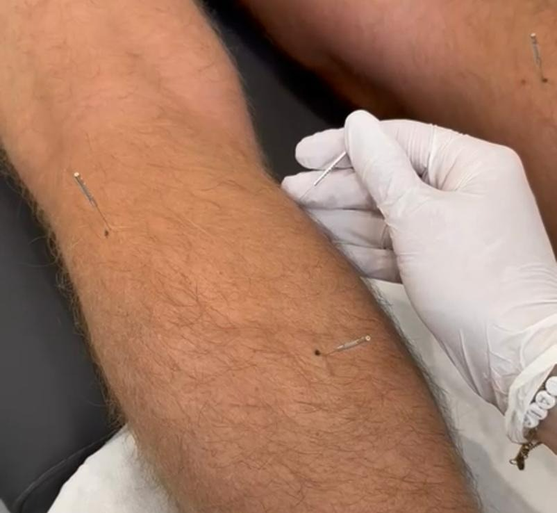 Western Medical Acupuncture (WMA)
