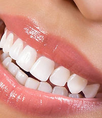 TEETH WHITENING London,ON