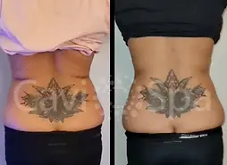 Fat Cellulite Reduction Body Contouring | CaviSpa | Tampa FL
