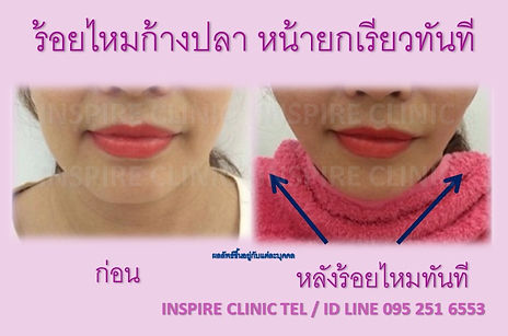 ร้อยไหมปรับรูปหน้า