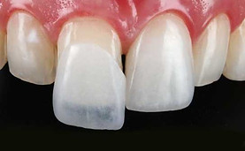 lamina-de-lente-de-contato-Clinica-Selec