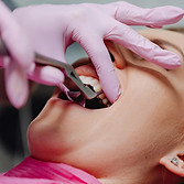 Wisdom tooth extraction