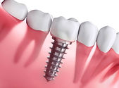 implantes-dentarios.jpg