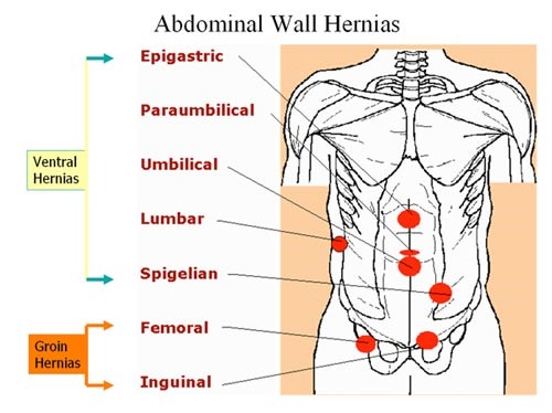 Abdominal Wall Hernias Abdominal Wall Hernias
