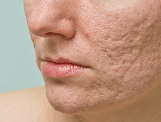 acne littekens man.png