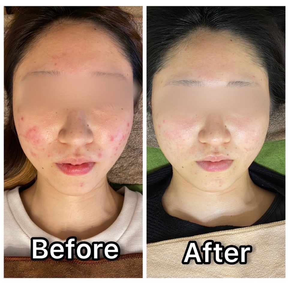 大人ニキビ　ポテンツァ　ハーブピーリング（エクソソーム入り）