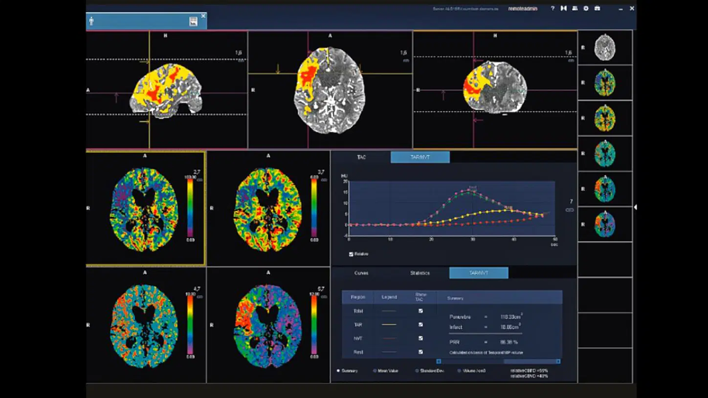 siemens-healthineers-ct-ct-imaging-in-neurology.webp