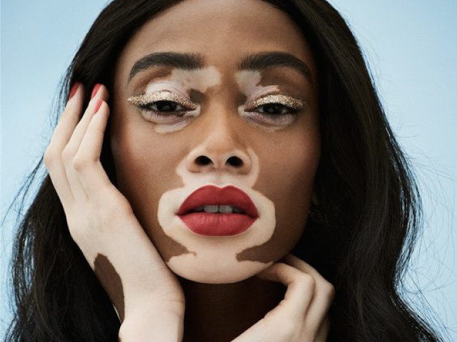 Vitiligo's Representation In Fashion