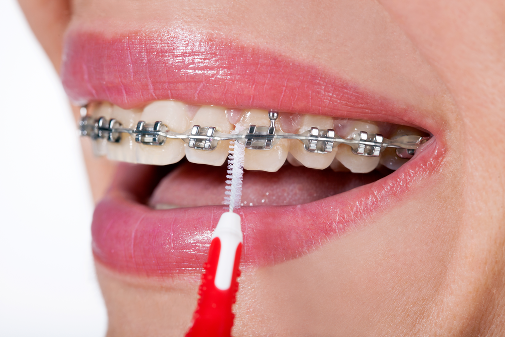 Why Do My Teeth Get Yellow With Braces