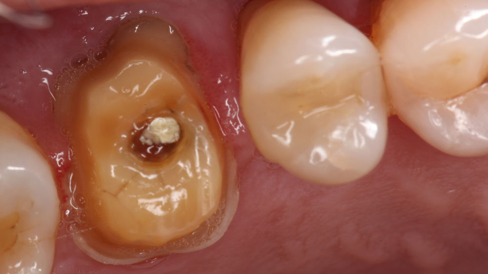 Emergency Temporary Crown