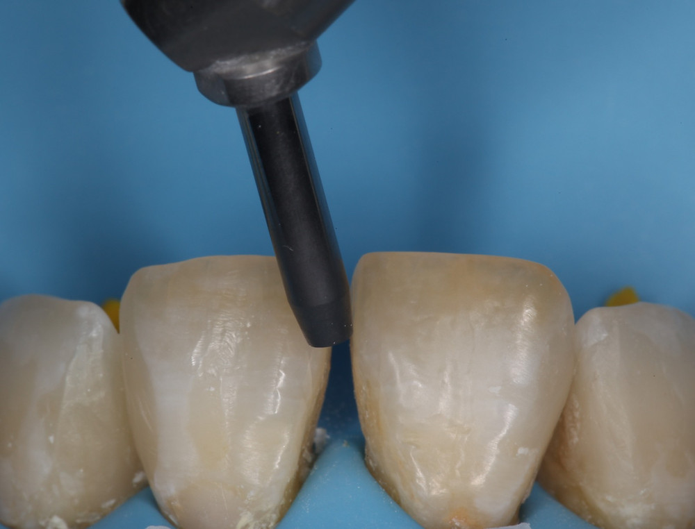 Air Abrasion (Sandblasting)