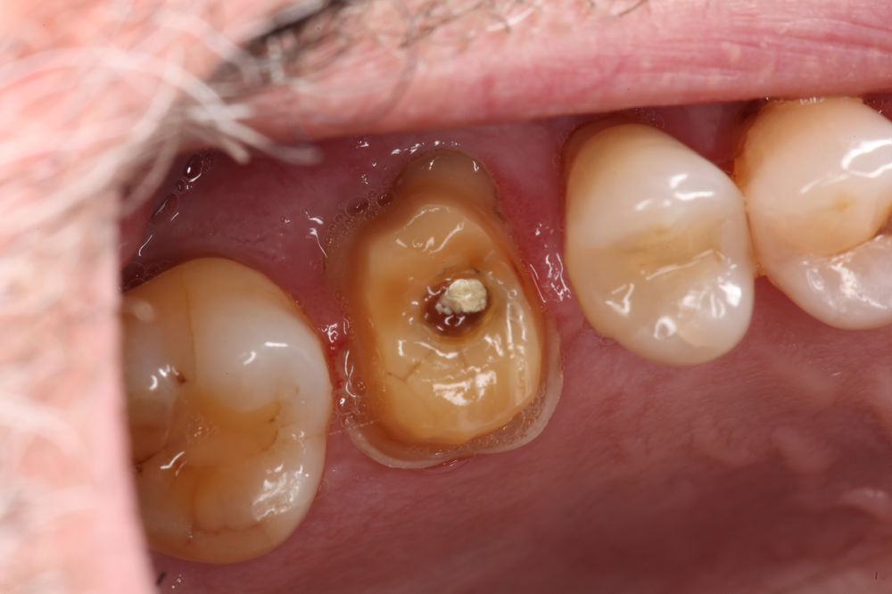 Emergency Temporary Crown