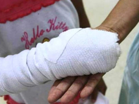 Nuevo caso de niño quemado por polvora