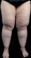 lipedemaleg.jpg
