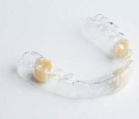 teilgebiss retainer.jpeg