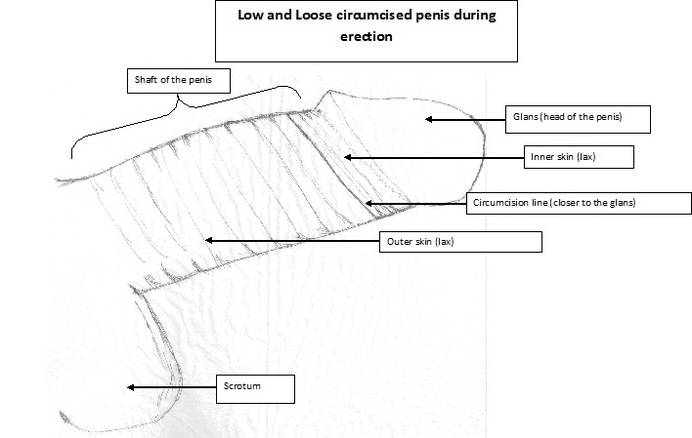 Circumcision Types | Circumcision Clinic | Circumcision in London