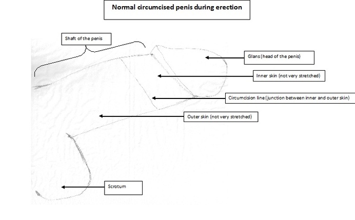 Circumcision Types | Circumcision Clinic | Circumcision in London