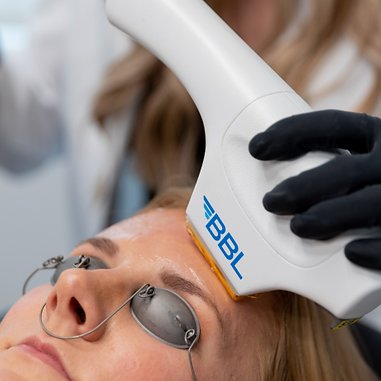 BBL laser for facial redness