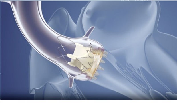 TAVI | Διαδερμική αντικατάσταση αορ