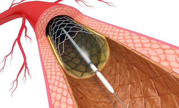 Αγγειοπλαστική στεφανιαίων | PCI | stent