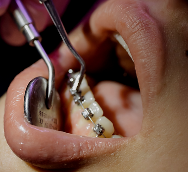 Brackets Autoligados de Clínica Beauty Dental