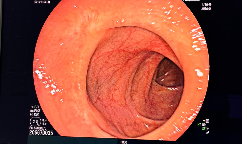 Colonoscopia: prevenção que salva vidas com tecnologia, precisão e experiência