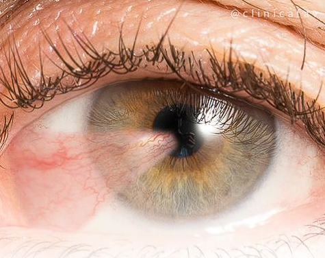 pterígio e como preveni-lo