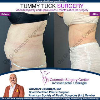 Tummy Tuck Turkey Antalya