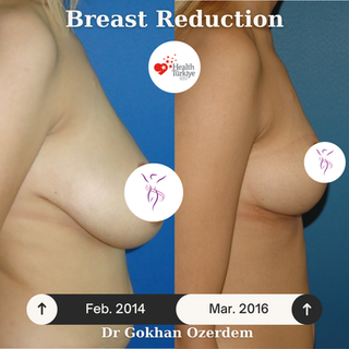 Breast Reduction Before After