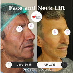 FACELIFTING (Rhytidektomie) In der Türkei Antalya