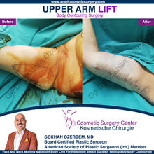 ARM LIFT BEFORE AFTER TURKEY ANTALYA