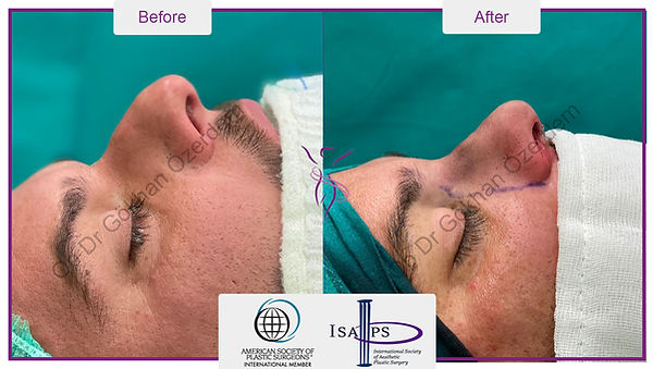 NASEN-ÄSTHETIK | NASENKORREKTUR RHINOPLASTIK Antalya Türkei