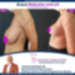 BREAST REDUCTION SURGERY IN TURKEY ANTALYA