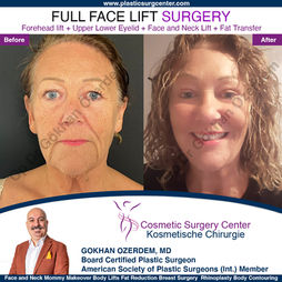 FACELIFTING (Rhytidektomie) In der Türkei Antalya