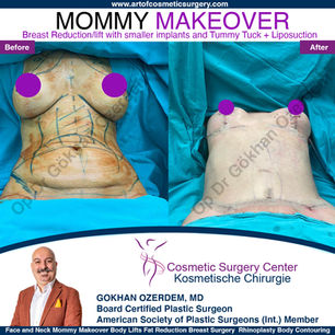 VERSCHÖNERUNG FÜR MAMAS MOMMY MAKEOVER Vorher Nachher Türkei Antalya