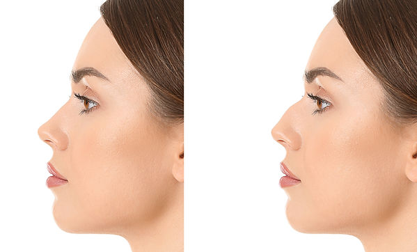 rhinoplasty in turkey antalya
