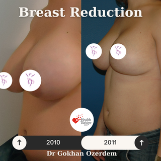 Breast Reduction Before After