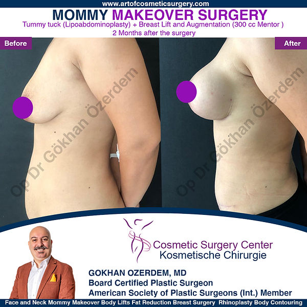 BREAST LIFT WITH IMPLANTS
