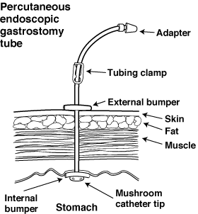 gasrostomy tube