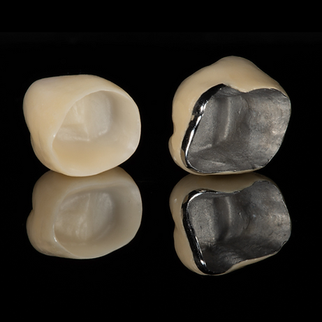 Dental Crown Treatment in Pimple Saudagar -MDS Specialist